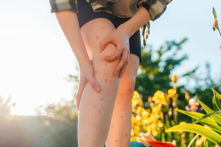 Frau steht im Garten mit Mückenstichen an den Beinen